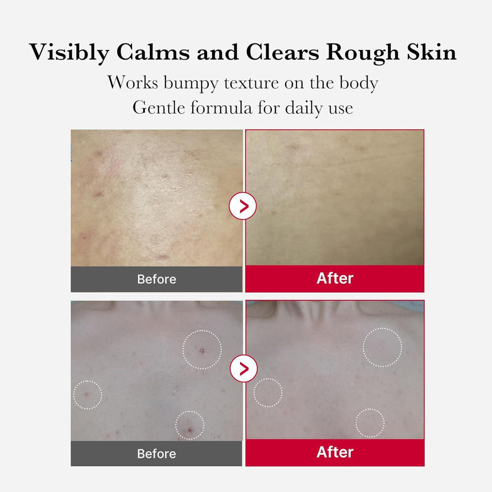 
                      
                        Medicube Red Acne Body Peeling Shot 美蒂秋芙温和去角质身体喷雾 110g
                      
                    