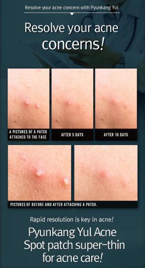 
                      
                        Pyunkang Yul Acne Spot Patch Super Thin 扁康率超薄祛痘贴 15pc
                      
                    
