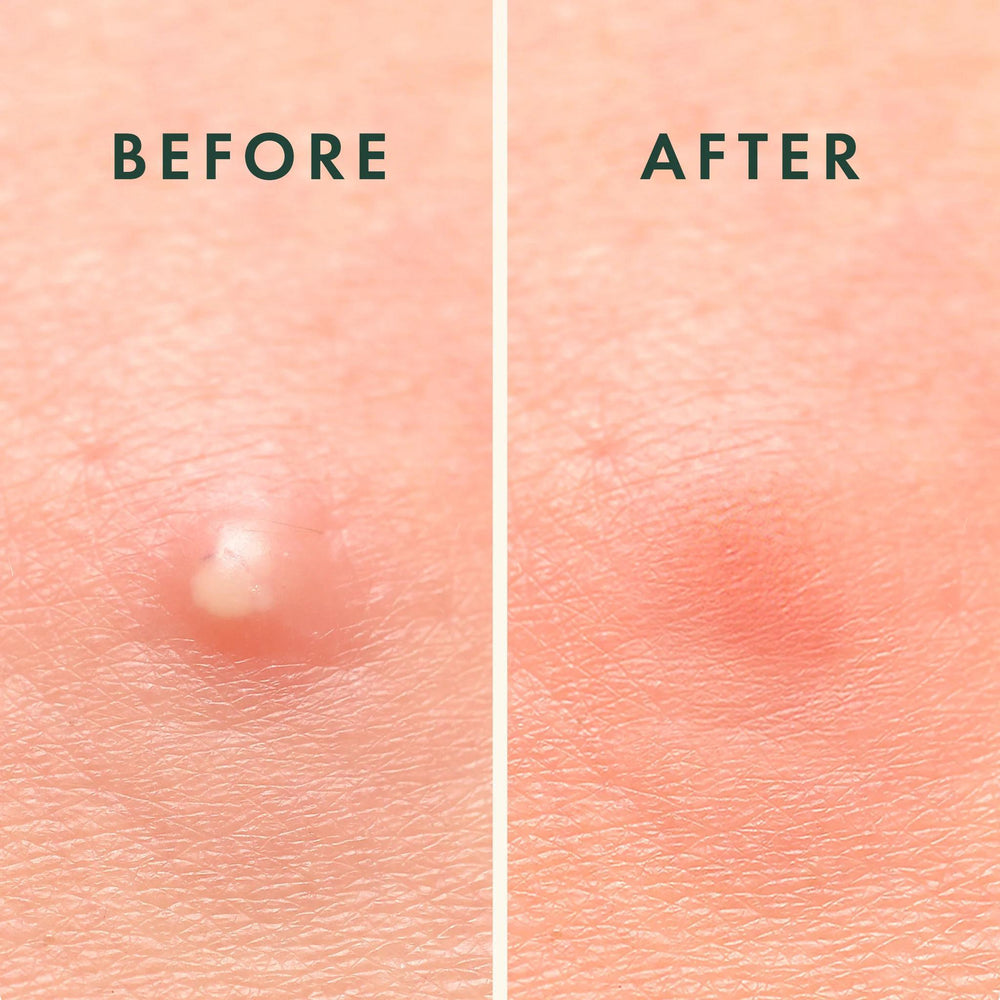 
                      
                        Rael Miracle Patch Overnight Spot Cover - Pimple Patch Acne 蕊友可夜用隐形痘痘贴 52 count
                      
                    
