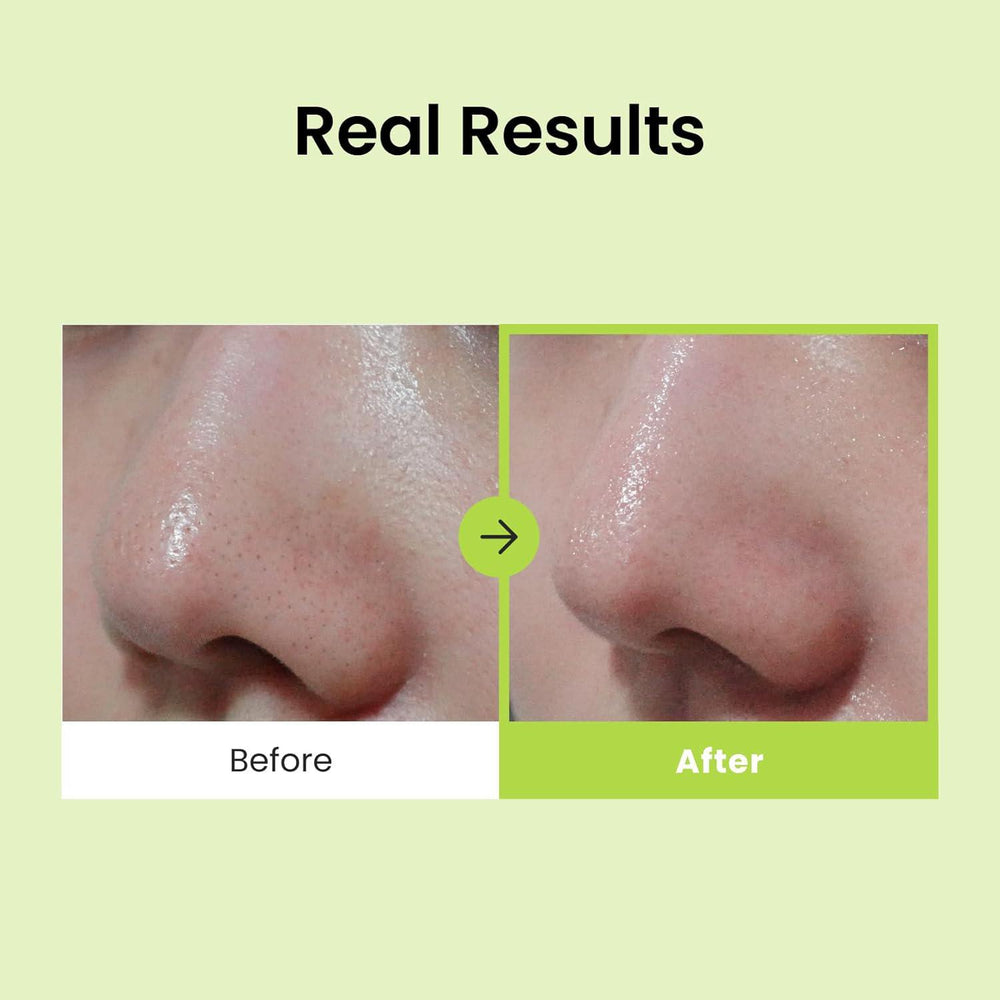 
                      
                        CNP Laboratory Blackhead Remover Nose Strip 希恩派深层毛孔清洁去黑头套装
                      
                    